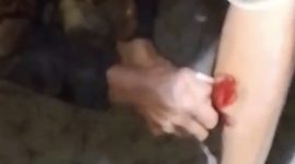 Kondisi korban saat digigit ular sawe | Foto : Zonamu/SS